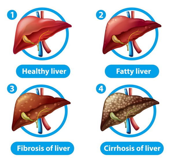 Liver Disease Progression
